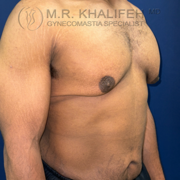 A man's torso and chest are shown from the side, displaying mild gynecomastia. The background is blue, and a medical specialist’s watermark is present at the top of the image.