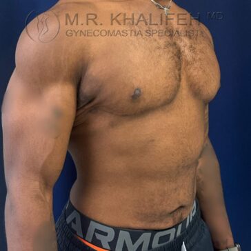 A shirtless person with a muscular torso stands against a dark background. The image shows the chest and upper arms, with some scarring visible on the chest.