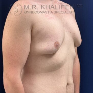 Adult male torso with visible gynecomastia on the left side, shown in a clinical setting against a dark background.