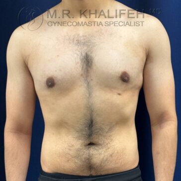 A shirtless adult male stands against a dark blue background, showing a flat chest and visible body hair. Text at the top reads “M.R. Khalifeh MD, Gynecomastia Specialist.”.