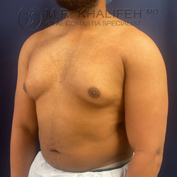 A shirtless man stands against a dark background, showing his chest and abdomen. The image includes text: "M.R. Khalifeh MD, Gynecomastia Specialist.