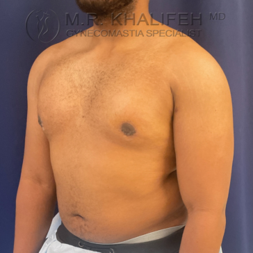 A man with gynecomastia stands shirtless against a blue background, showing his chest and upper torso from a left-side angle.