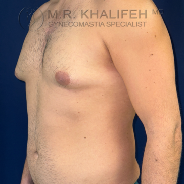 Adult male torso with visible gynecomastia, photographed from the left side against a blue background. Text on the image indicates a gynecomastia specialist.