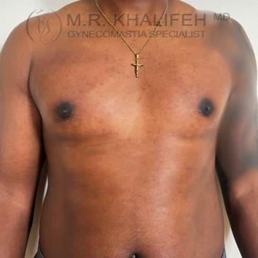 A shirtless person with visible gynecomastia stands facing forward. Text at the top reads "M.R. Khalifeh MD, Gynecomastia Specialist.