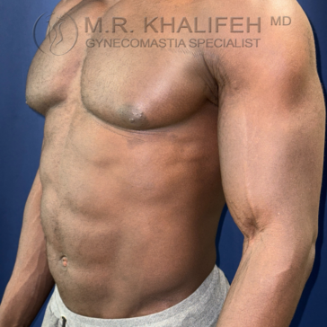 A shirtless man’s upper body is shown from the side, highlighting the chest and abdomen. “Gynecomastia Specialist” and a doctor’s name are visible as a watermark on the image.