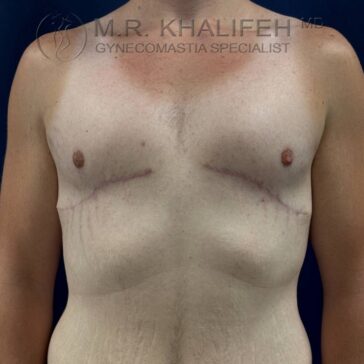 A man's bare chest with visible post-surgical scars under both nipples, suggesting recent gynecomastia surgery. The image background is dark blue.