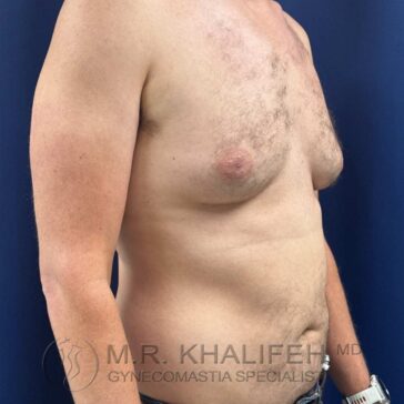 A shirtless male torso with visible gynecomastia, standing against a dark blue background.