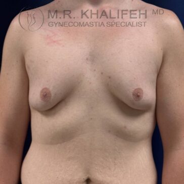 Bare chest of an individual with visible gynecomastia, photographed from the front against a dark blue background. Text at top indicates a gynecomastia specialist.