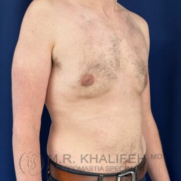 A shirtless adult male with visible gynecomastia on his right side, standing against a dark blue background.