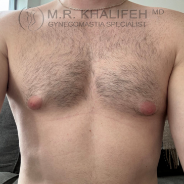 A shirtless male chest with visible gynecomastia, slight asymmetry, and some chest hair. The watermark reads “M.R. Khalifeh MD Gynecomastia Specialist.”.