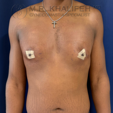 A person with surgical bandages on their chest stands against a dark blue background, wearing a necklace. "Gynecomastia Specialist" is visible in text at the top of the image.