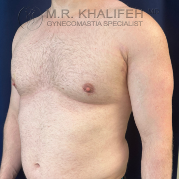 Adult male torso shown from an angle, shirtless, with visible chest and abdominal area. Text overlay reads "M.R. Khalifeh MD Gynecomastia Specialist.