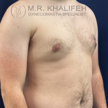 A shirtless person with visible gynecomastia stands against a dark blue background. The image includes the text "M.R. Khalifeh, MD Gynecomastia Specialist.