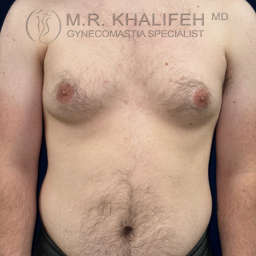 A shirtless adult male torso is shown from the neck to the waist, with visible enlarged breast tissue. The background is plain and dark.