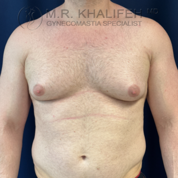 A shirtless adult male with visible gynecomastia stands against a dark background; "Gynecomastia Specialist" is labeled at the top.