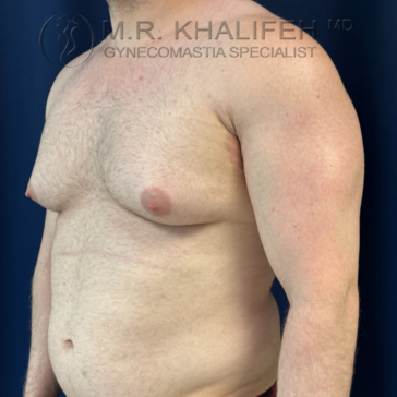 Adult male with visible enlargement of breast tissue, standing shirtless against a blue background. The image includes watermark text identifying a gynecomastia specialist.