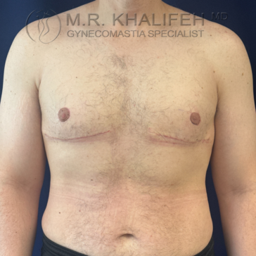 A person’s bare chest shows healed surgical scars beneath both nipples, indicating recent gynecomastia surgery.