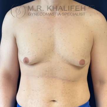 A person with a bare chest, standing against a dark background. The image features the upper torso with visible post-surgical marks. Text overlay at the top reads “M.R. Khalifeh, MD Gynecomastia Specialist.”.