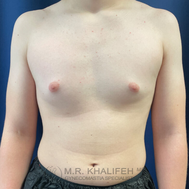 A person with a bare chest stands against a blue background, showing mild swelling around the nipple area on both sides.