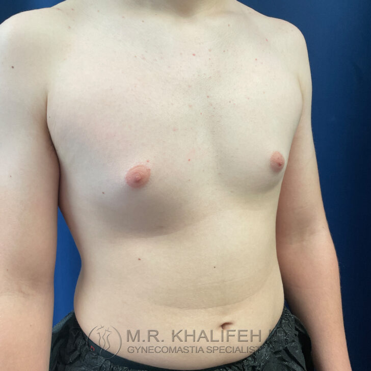 A person with a bare chest showing mild gynecomastia, standing against a blue background. Text at the bottom reads “M.R. Khalifeh Gynecomastia Specialist.”.