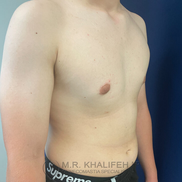 A shirtless person with mild gynecomastia standing in front of a blue background, wearing black shorts.