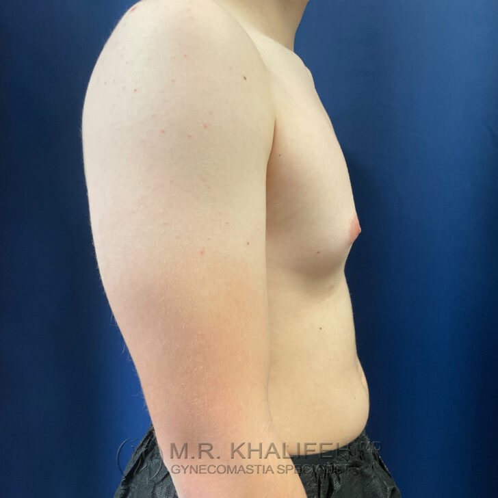 Side profile of a shirtless person with a slightly enlarged breast area, standing in front of a blue background.
