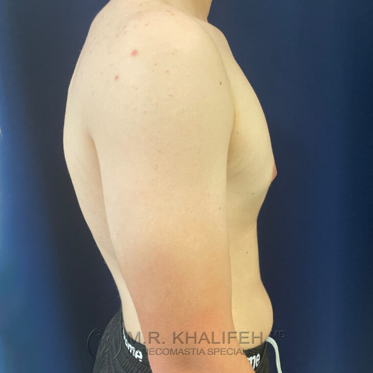 A side view of a shirtless person with light skin standing against a dark blue background. The person's right arm is visible.