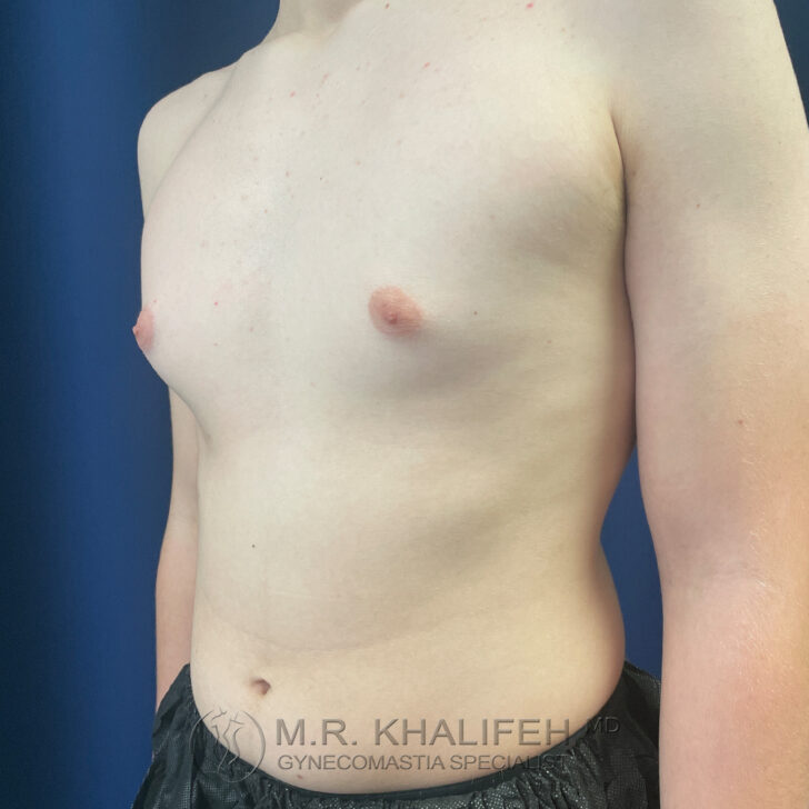 A shirtless person with a visible chest bulge stands against a blue background, with text at the bottom reading “M.R. Khalifeh MD Gynecomastia Specialist.”.