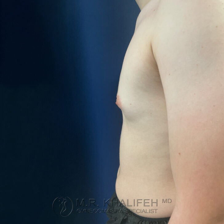 A side view of a person's bare upper torso showing mild breast tissue enlargement.