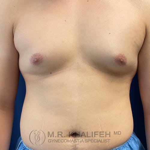 A person with visible gynecomastia, showing enlarged breast tissue on both sides of the chest, standing against a dark background.