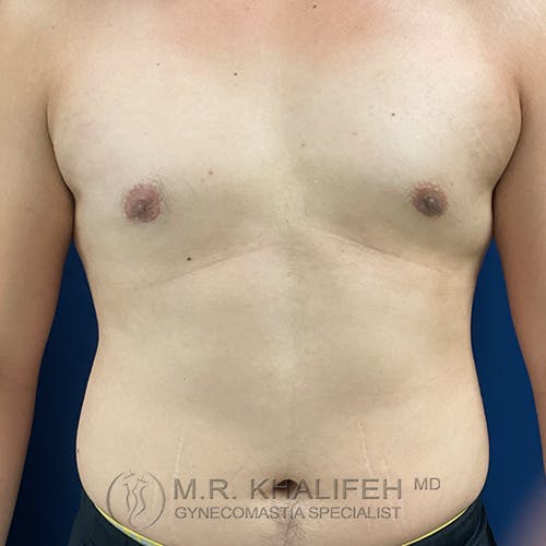 A shirtless person with a flat chest and light skin is standing upright against a blue background. The words "M.R. Khalifeh MD Gynecomastia Specialist" appear at the bottom.