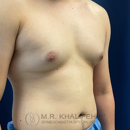 A person with visible gynecomastia, showing enlarged breast tissue on the chest, standing against a dark background.