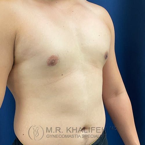 A person’s bare chest and abdomen are shown from the side, with visible post-surgical lines under the nipples.