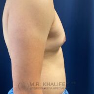Side view of a person's bare chest and abdomen against a dark blue background, showing enlarged breast tissue.