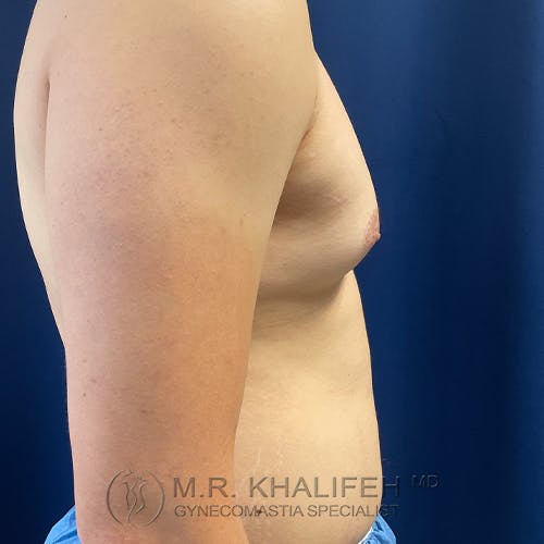 Side view of a person's bare chest and abdomen against a dark blue background, showing enlarged breast tissue.