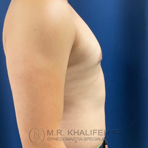 A shirtless person with a bare chest is shown in profile against a blue background. The image includes a watermark for a gynecomastia specialist.