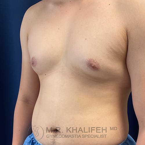 A shirtless person with visible enlargement of breast tissue on the chest, indicative of gynecomastia, standing against a dark blue background.