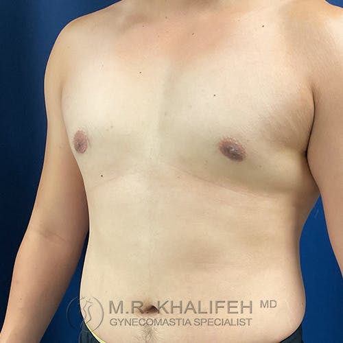 A person’s bare chest is shown from the front and side, with visible flat contours and small areolas. Text at the bottom reads “M.R. Khalifeh MD Gynecomastia Specialist.”.
