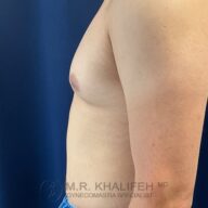 Side view of a shirtless person's chest, showing slight enlargement of breast tissue, with a logo and text reading "M.R. Khalifeh MD Gynecomastia Specialist" at the bottom.
