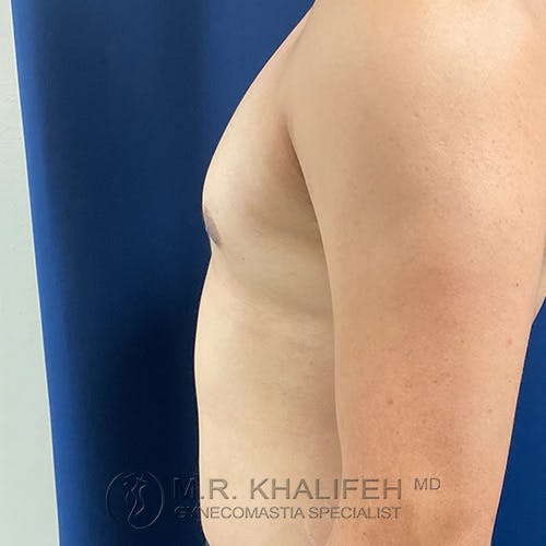 Side view of a shirtless person’s upper torso against a blue background, showing mild enlargement of breast tissue.