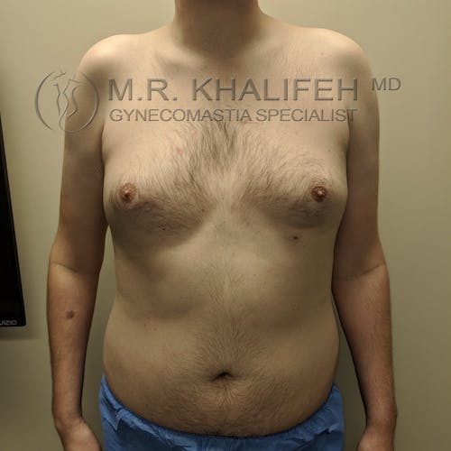 A shirtless person with visible gynecomastia stands facing forward against a neutral background. The logo "M.R. Khalifeh MD Gynecomastia Specialist" is overlaid on the image.