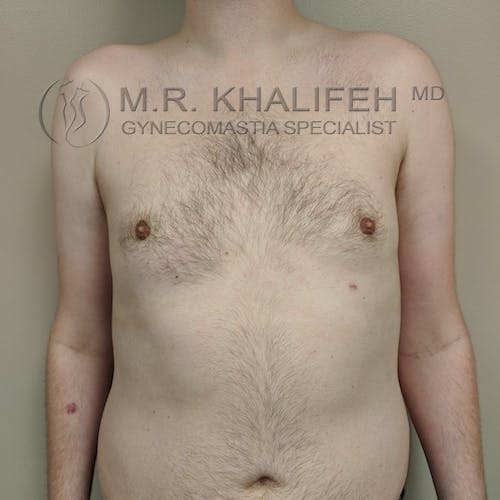 A shirtless adult male with mild gynecomastia stands facing forward against a plain background. Branding for a gynecomastia specialist is visible at the top of the image.