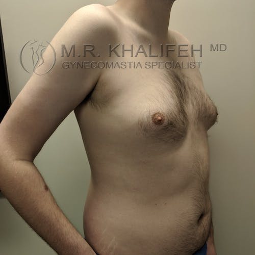 A person with visible gynecomastia, showing enlarged breast tissue on the chest, standing in a clinical setting.
