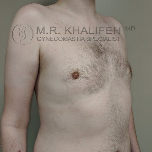 A shirtless person with visible gynecomastia stands against a plain background. Text on image reads: "M.R. Khalifeh MD Gynecomastia Specialist.
