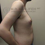 A shirtless man is shown from the side against a plain background, displaying mild breast enlargement and abdominal fullness. Text reads: "M.R. Khalifeh MD, Gynecomastia Specialist.