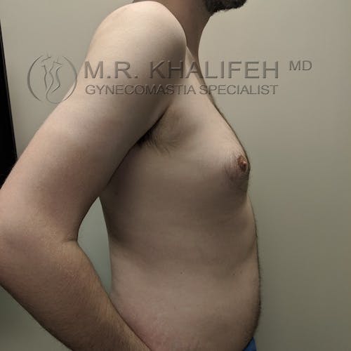 A shirtless man is shown from the side against a plain background, displaying mild breast enlargement and abdominal fullness. Text reads: "M.R. Khalifeh MD, Gynecomastia Specialist.