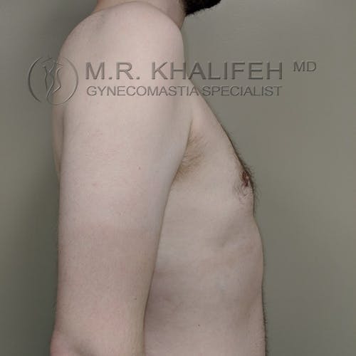 Side view of a shirtless man standing against a neutral background, showing his chest and upper torso. "M.R. Khalifeh MD Gynecomastia Specialist" watermark is visible.