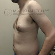 Side view of a shirtless man with visible gynecomastia in a medical office, showing chest and abdomen; watermark indicates gynecomastia specialist.