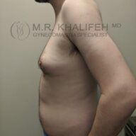 Side view of a shirtless adult male torso with visible gynecomastia, standing against a plain background.