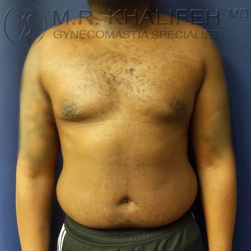 A shirtless person stands facing forward, showing a mildly enlarged chest and abdomen against a blue background. Text at the top indicates a gynecomastia specialist.
